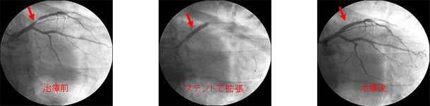 ステント留置術