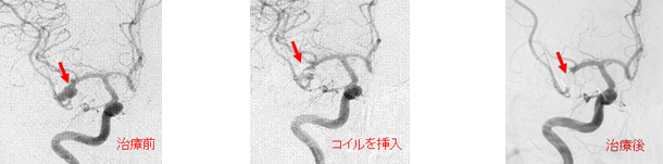 コイル塞栓術