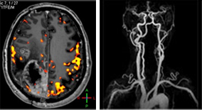 MRI